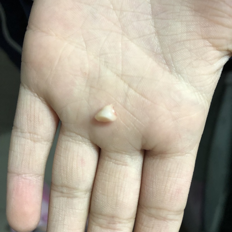 儿童掉牙换牙齿