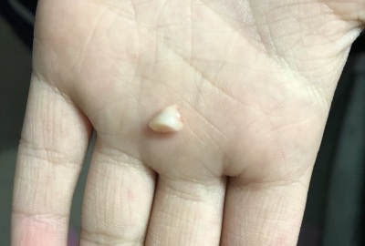 儿童掉牙换牙齿