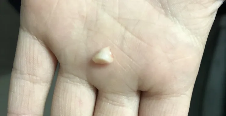 儿童掉牙换牙齿